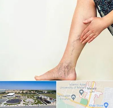 دکتر واریس در ملارد