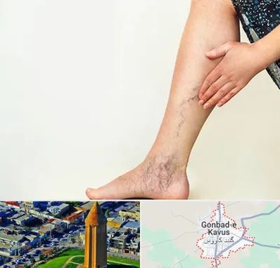 دکتر واریس در گنبد کاووس