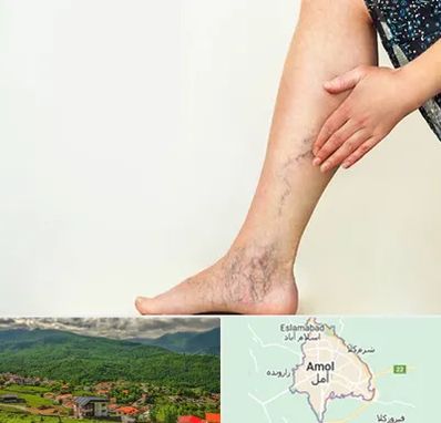 دکتر واریس در آمل