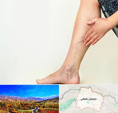 دکتر واریس در خراسان شمالی