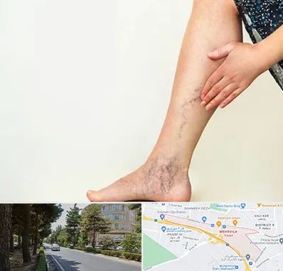 دکتر واریس در مهرویلا کرج 