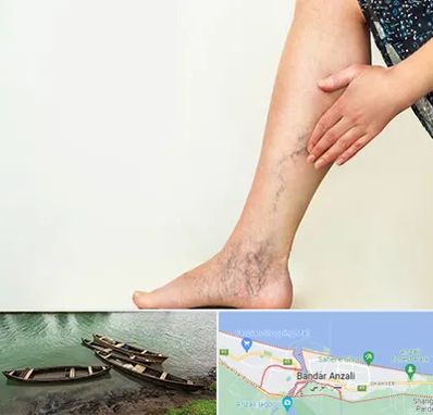 دکتر واریس در بندر انزلی