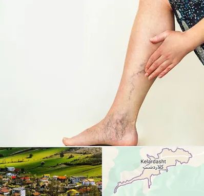 دکتر واریس در کلاردشت