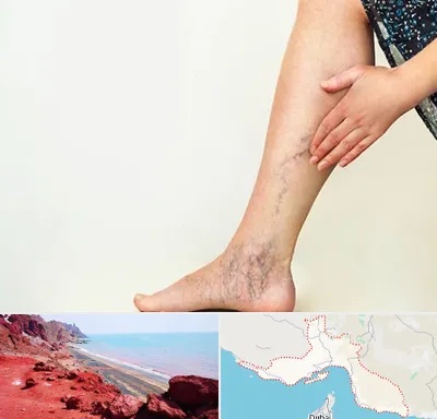 دکتر واریس در هرمزگان