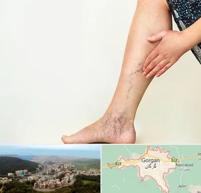 دکتر واریس در گرگان