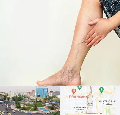 دکتر واریس در ونک 