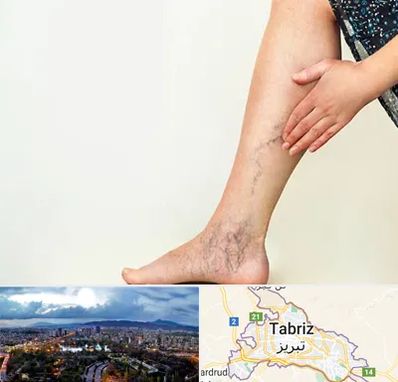 دکتر واریس در تبریز