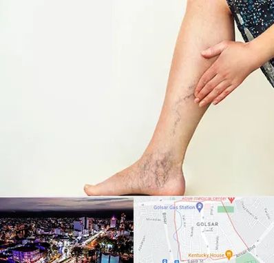 دکتر واریس در گلسار رشت 