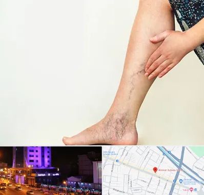 دکتر واریس در آبرسان تبریز