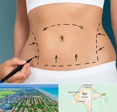 عمل ابدومینوپلاستی در ساری