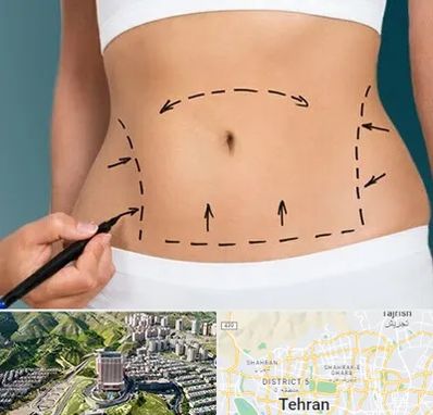 عمل ابدومینوپلاستی در شمال تهران