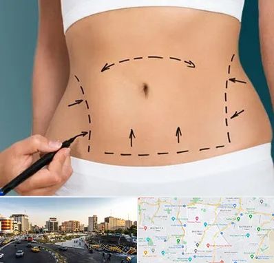 عمل ابدومینوپلاستی در منطقه 7 تهران