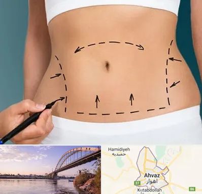 عمل ابدومینوپلاستی در اهواز