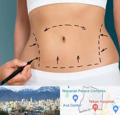 عمل ابدومینوپلاستی در آجودانیه