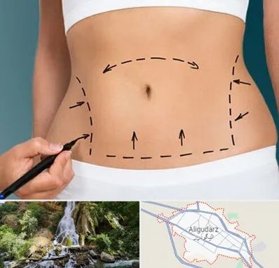 عمل ابدومینوپلاستی در الیگودرز