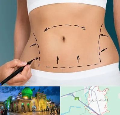 عمل ابدومینوپلاستی در آستانه اشرفیه