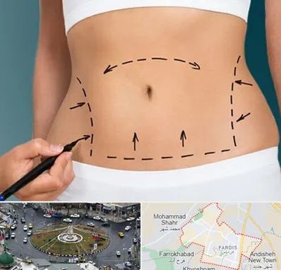 عمل ابدومینوپلاستی در فردیس کرج