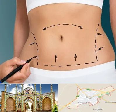 عمل ابدومینوپلاستی در سمنان