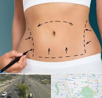 عمل ابدومینوپلاستی در منطقه 17 تهران