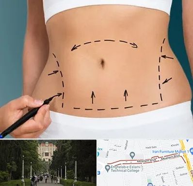 عمل ابدومینوپلاستی در بلوار معلم رشت