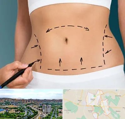 عمل ابدومینوپلاستی در شهریار