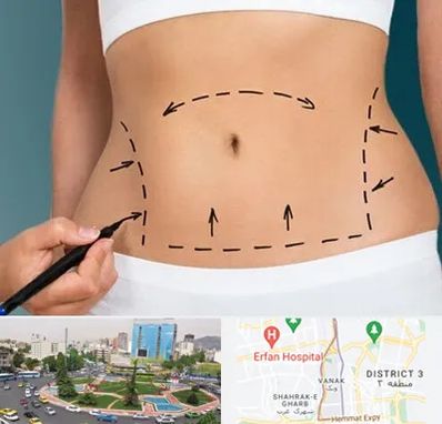 عمل ابدومینوپلاستی در ونک تهران