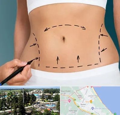 عمل ابدومینوپلاستی در رودسر