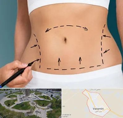 عمل ابدومینوپلاستی در ورامین