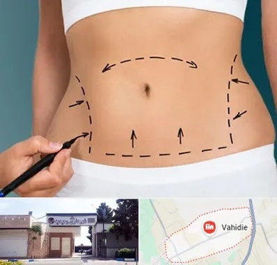 عمل ابدومینوپلاستی در وحیدیه شهریار