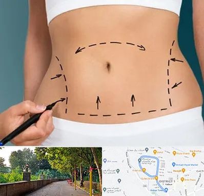 عمل ابدومینوپلاستی در بلوار گیلان رشت