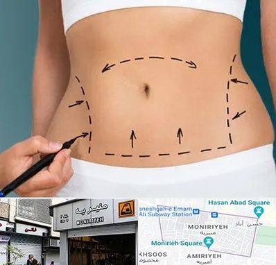 عمل ابدومینوپلاستی در منیریه