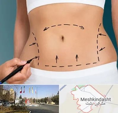 عمل ابدومینوپلاستی در مشکین دشت