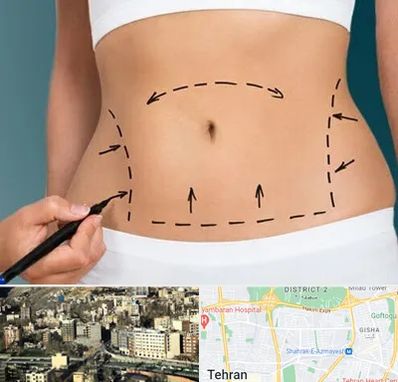 عمل ابدومینوپلاستی در مرزداران