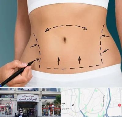 عمل ابدومینوپلاستی در ایران زمین