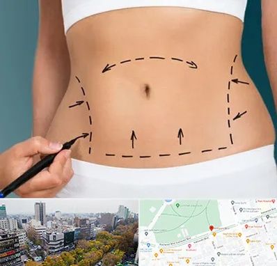 عمل ابدومینوپلاستی در بلوار کشاورز