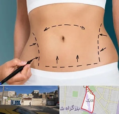 عمل ابدومینوپلاستی در اتابک