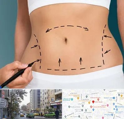 عمل ابدومینوپلاستی در فاطمی