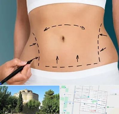 عمل ابدومینوپلاستی در مرداویج اصفهان