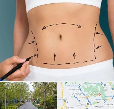 عمل ابدومینوپلاستی در قدوسی غربی شیراز