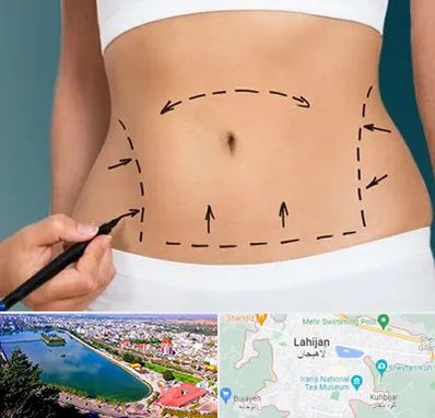 عمل ابدومینوپلاستی در لاهیجان