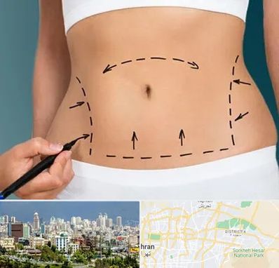 عمل ابدومینوپلاستی در شرق تهران تهران
