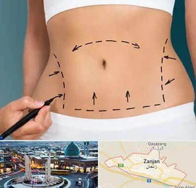 عمل ابدومینوپلاستی در زنجان