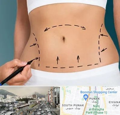 عمل ابدومینوپلاستی در پونک