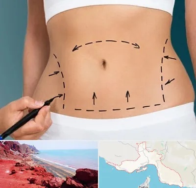 عمل ابدومینوپلاستی در هرمزگان
