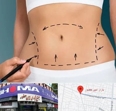 عمل ابدومینوپلاستی در امین حضور