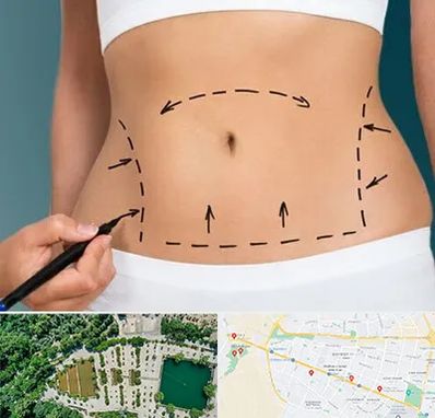 عمل ابدومینوپلاستی در وکیل آباد مشهد