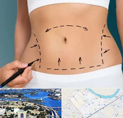 عمل ابدومینوپلاستی در کوروش اهواز