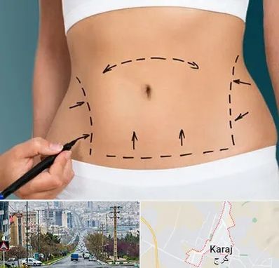 عمل ابدومینوپلاستی در گوهردشت