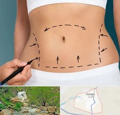 عمل ابدومینوپلاستی در کردان