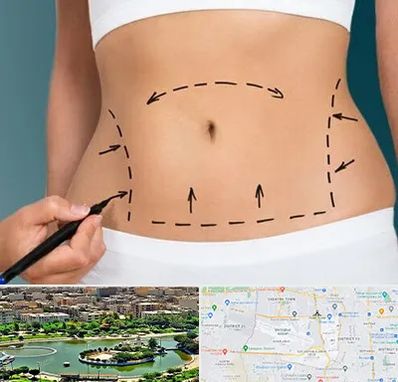 عمل ابدومینوپلاستی در منطقه 9 تهران